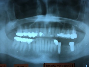 Implants placed in jaw.