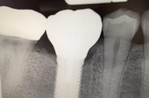 implant x-ray