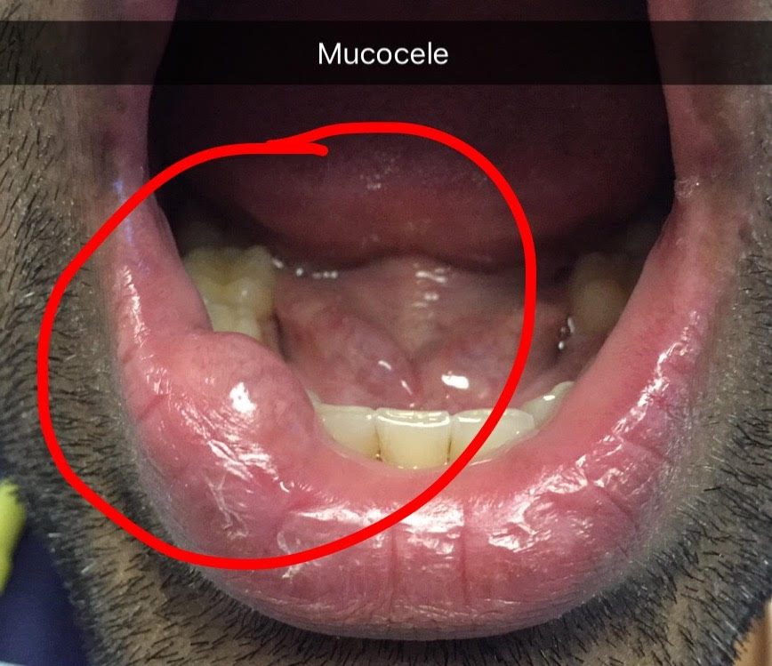 mucocele floor of mouth