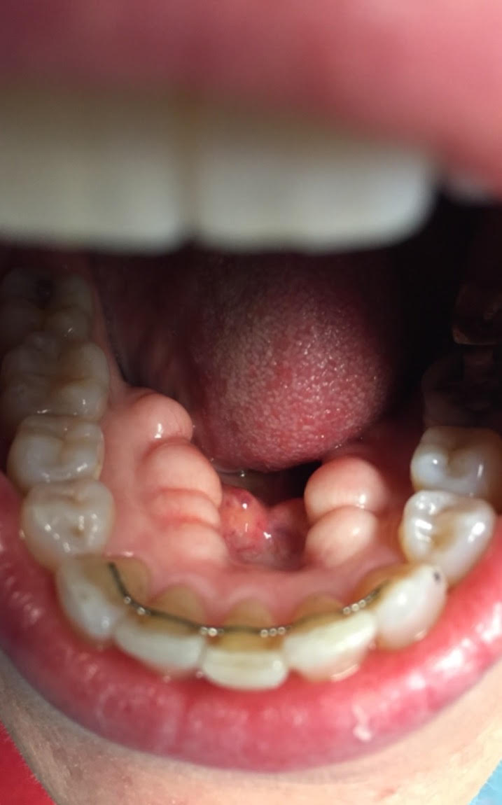 Bony Bump Under Tongue Canker Sore Vs Cancer Is Your Mouth Sore Bony Bump Under Tongue Canker Sore Vs Cancer Is Your Mouth Sore