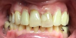 valplast partial denture after