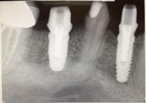implant x-ray