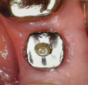 implant8