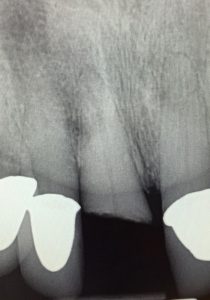 fractured tooth