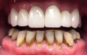 after-upper crowns 1 year later