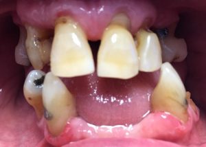 immediate-denture-before
