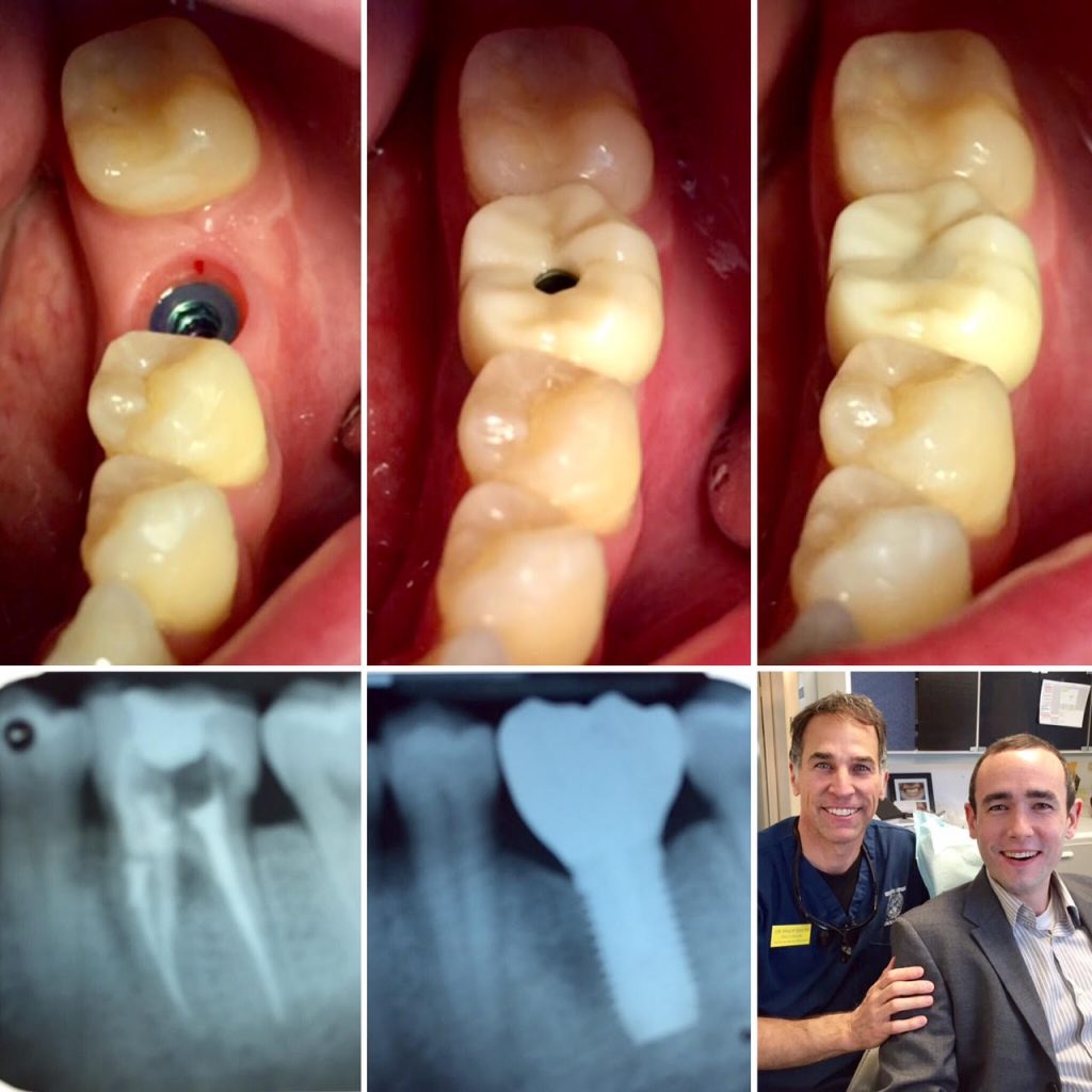 Dr Gentry dental implant