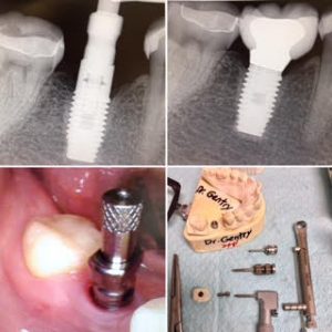 dental-implant-x-rays