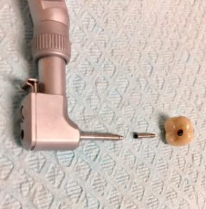 implant-crown-screw