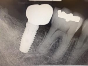 implant-tooth#31