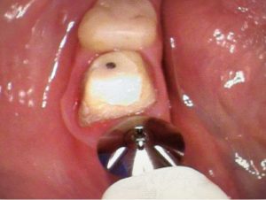 healing_abutment_crown_build-up