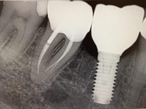 parfect_crown_&_dental_implant