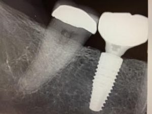 implant_seating_check_x-ray