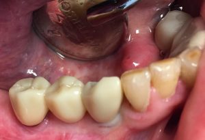 dental_implant_bridge