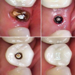 dental-implant-photos