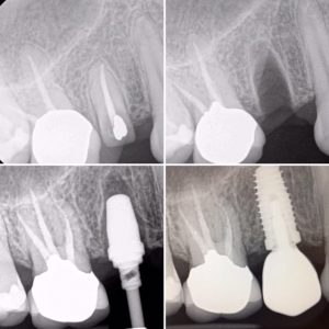 dental-implant-xrays