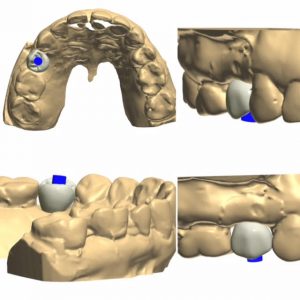 dentalimplant-design-images
