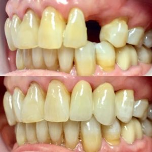 dental_porcelain_bridge
