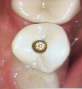 dental_implant6