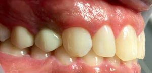 dental_implant_after