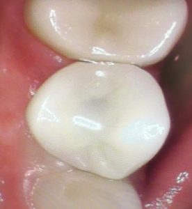 dental_implant_finished