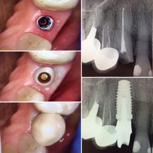 dental_implant_images