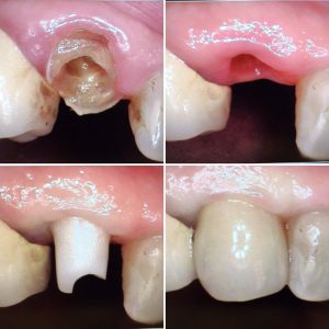 dental_implant_zirconia_abutment