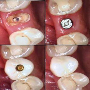 dental-implant-clinical-photos