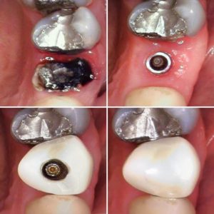 dental_implant_clinical_photos