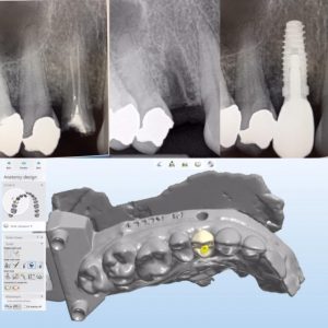 dental_implant_xrays_design_image