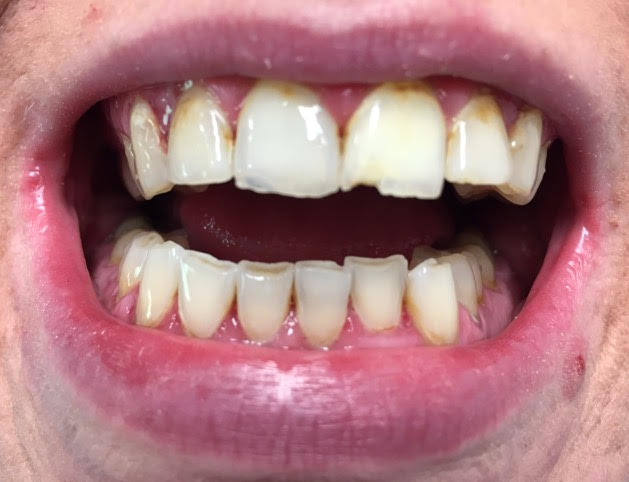 Chipped Teeth Beforeafter Dr Gentry