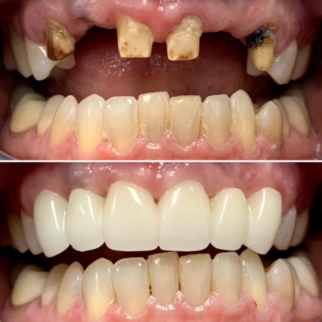 Dental Bridge Front Teeth